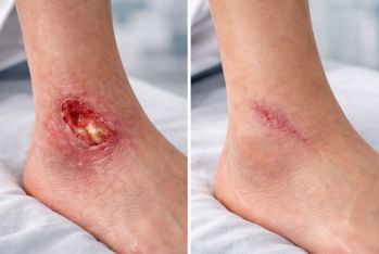 Wound care